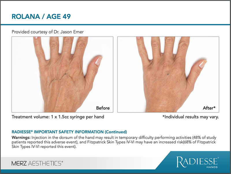 RADIESSE® Hand Rejuvenation before and after comparison image - ROLANA age 49