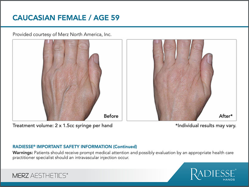 RADIESSE® Hand Rejuvenation before and after comparison image - CAUCASIAN FEMALE age 59